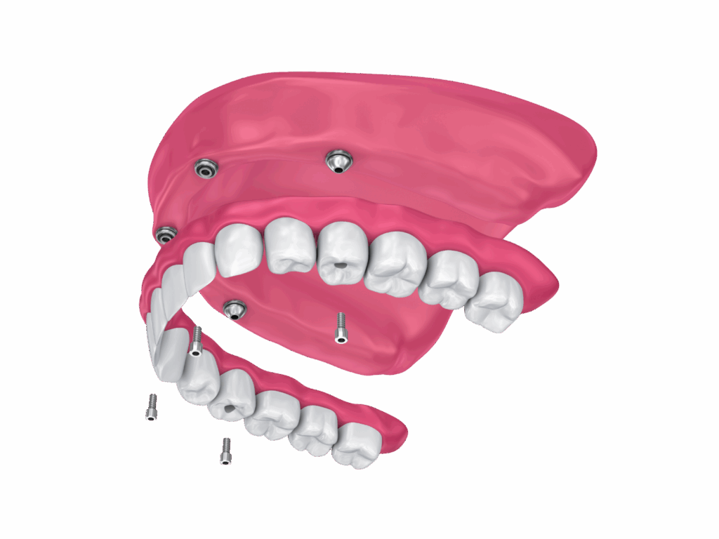 Illustrazione tecnica dell'overdenture su impianti