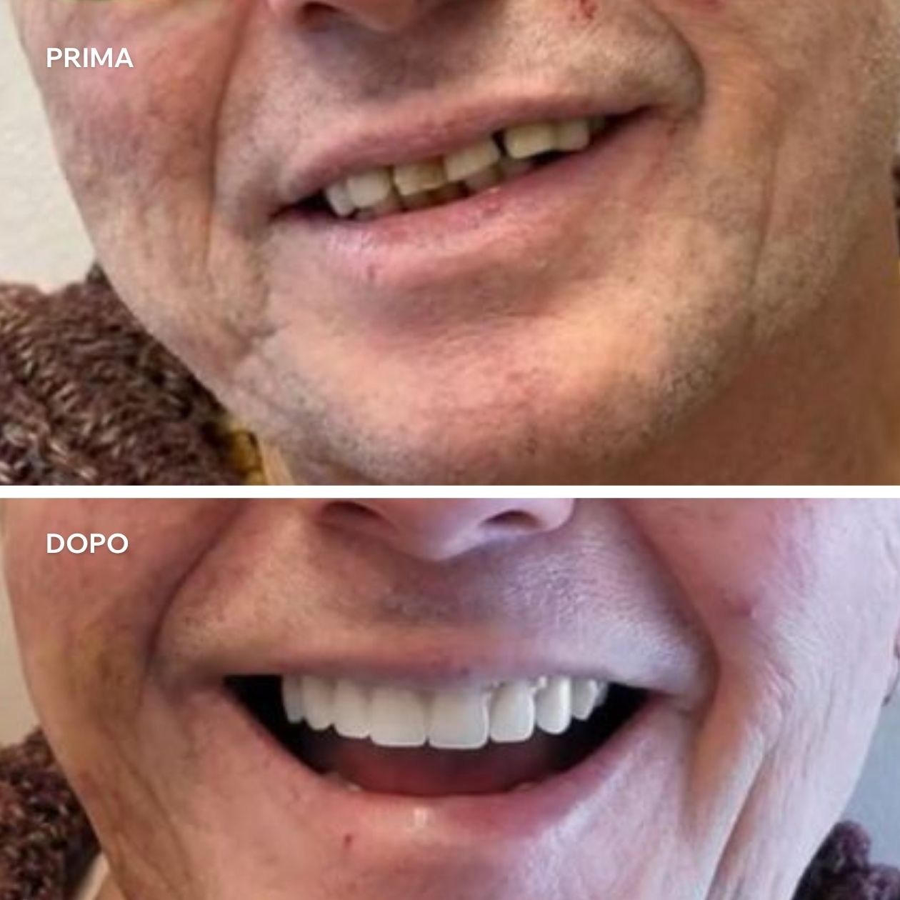 Sorriso nuovo dopo impianto a carico immediato