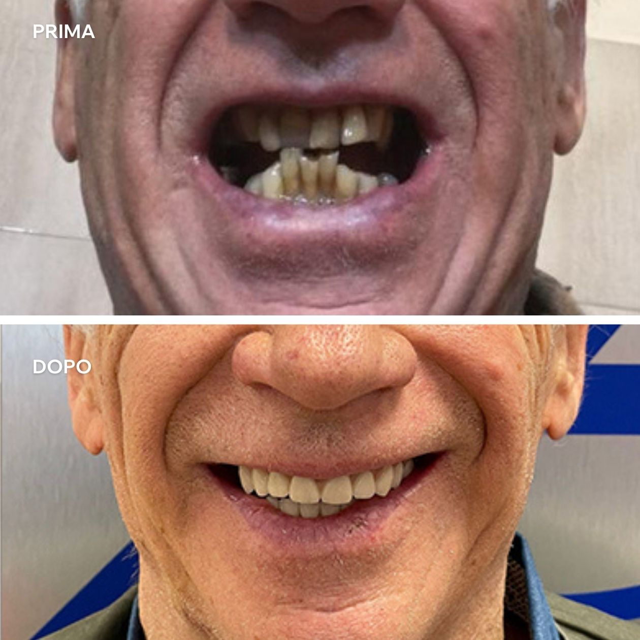 Sorriso prima e dopo di un cliente a seguito di implantologia a carico immediato