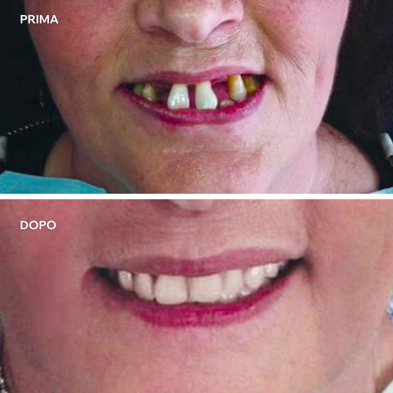 Risultato di un intervento di implantologia a carico immediato