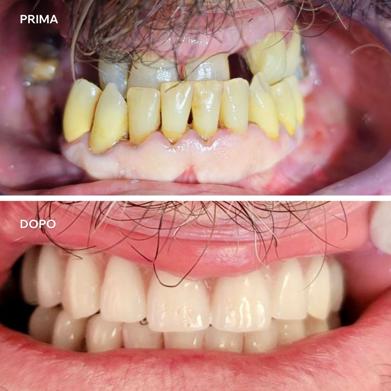 Impianto stabile e confortevole, implantologia a carico immediato