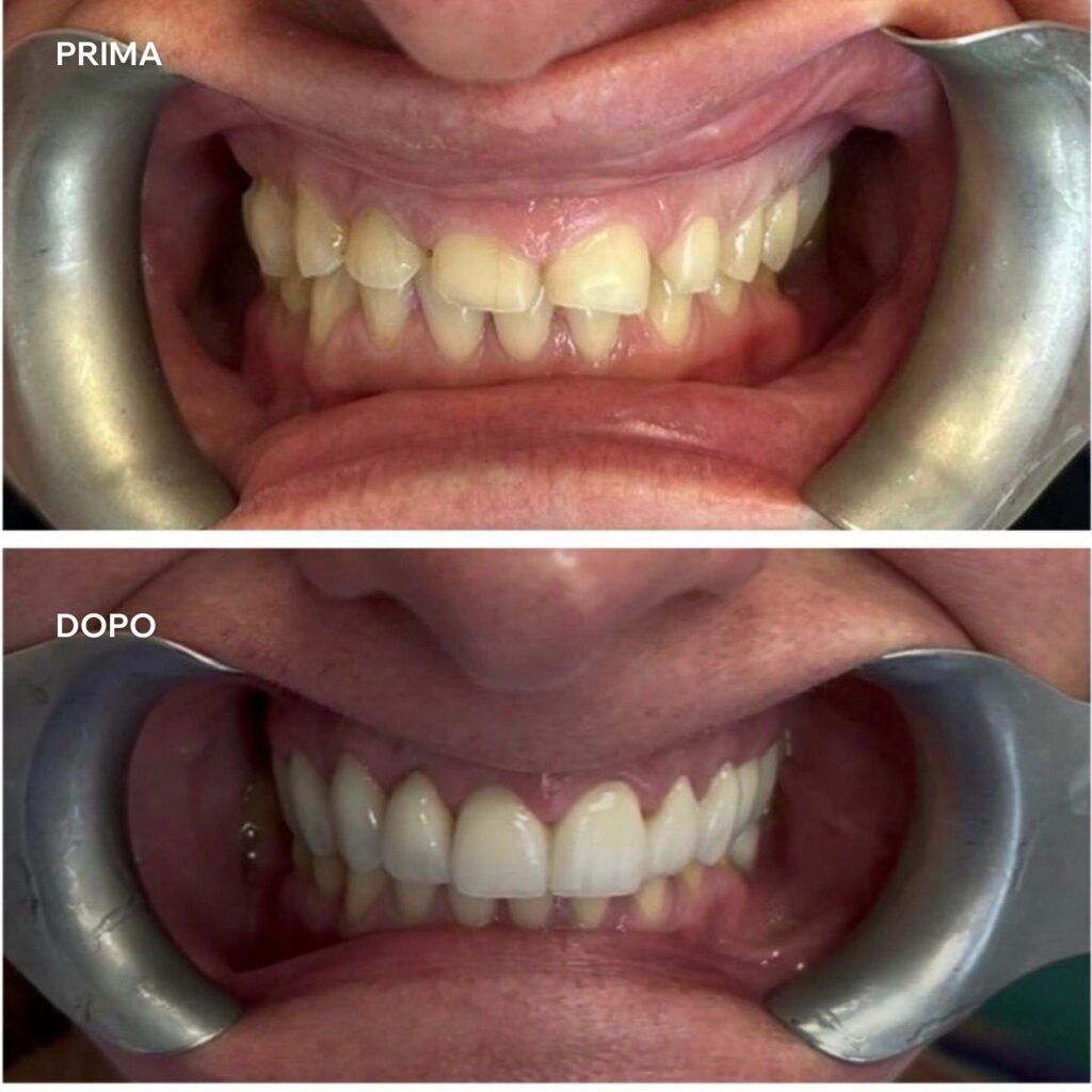 centri dentali zanardi prima e dopo