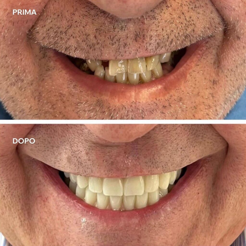 impianti dentali prima e dopo