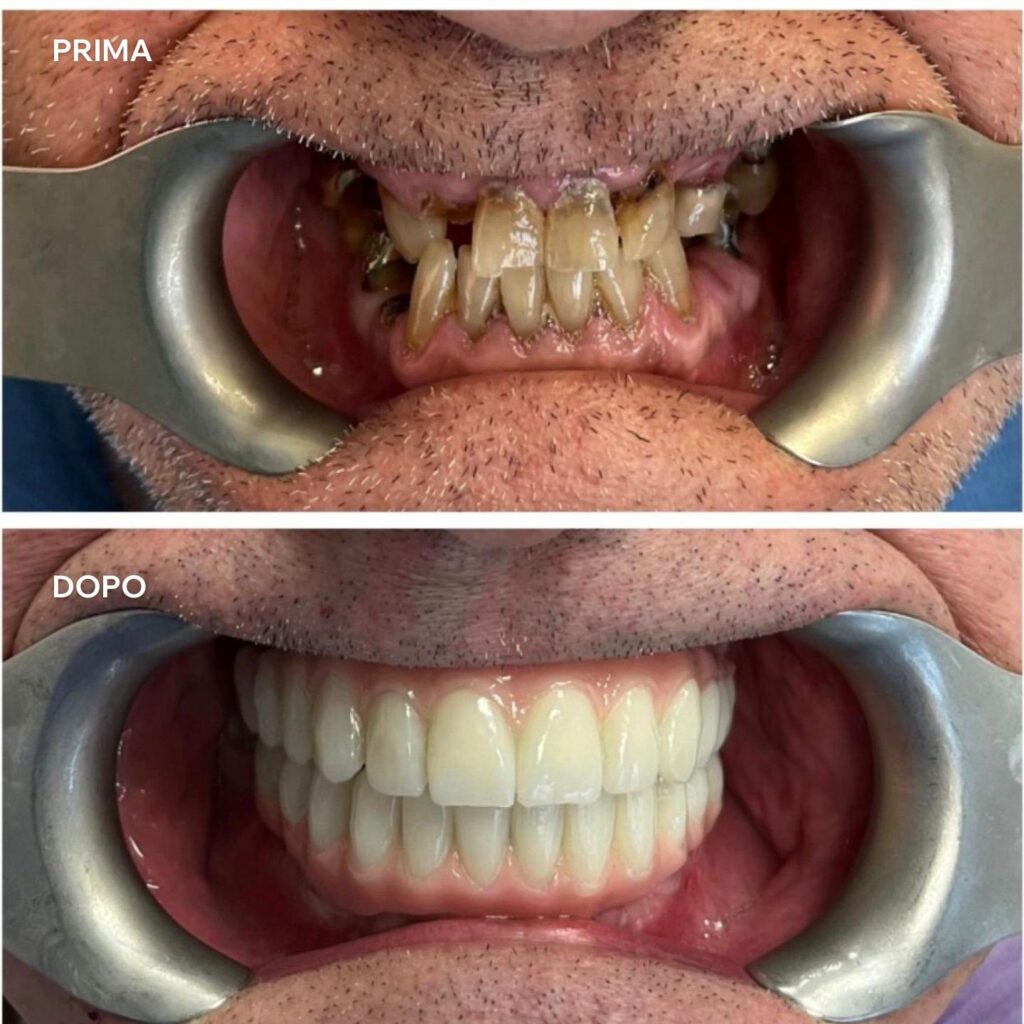 impianto dentale prima e dopo