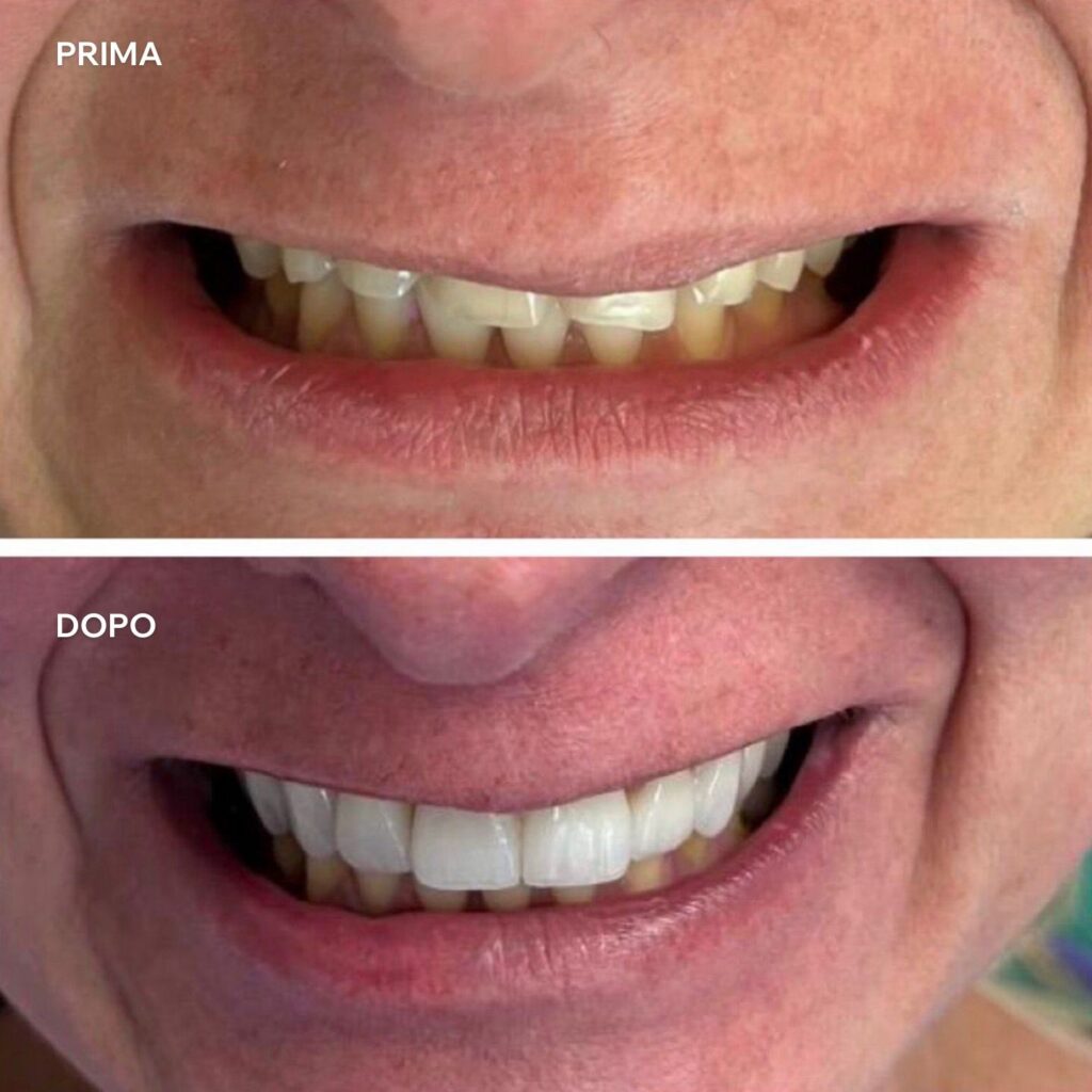 implantologia prima e dopo