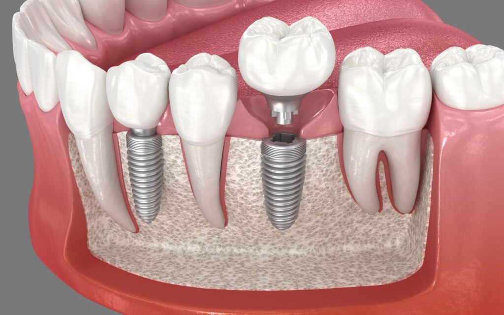 Quanto dura un impianto dentale? Tutto quello che c’è da sapere su durata e manutenzione