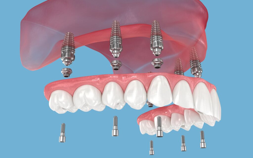 Come prendersi cura del tuo impianto dentale a casa per prolungarne la durata