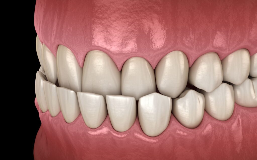 Malocclusione dentale: sintomi da non sottovalutare e trattamenti possibili