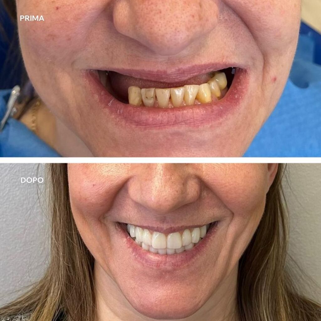 prima-dopo implantologia a carico immediato centri dentali zanardi