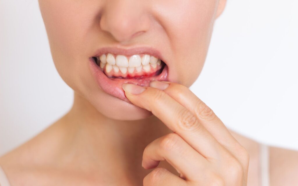 Gengivite: sintomi da riconoscere per prevenire complicazioni