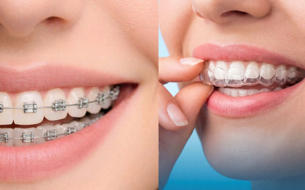 Meglio apparecchio fisso o mobile? - Centri Dentali Zanardi