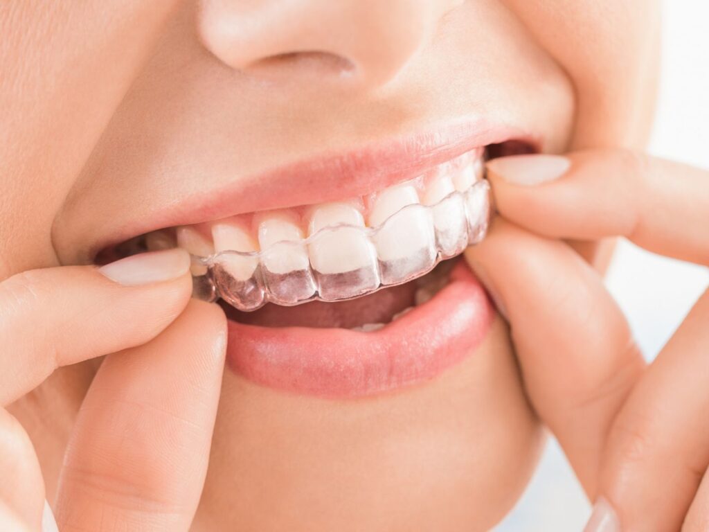 Mascherine per lo sbiancamento dentale professionale e domicilio