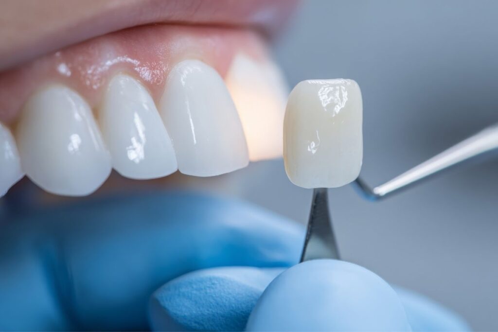 Faccette dentali estetiche Centri Dentali Zanardi
