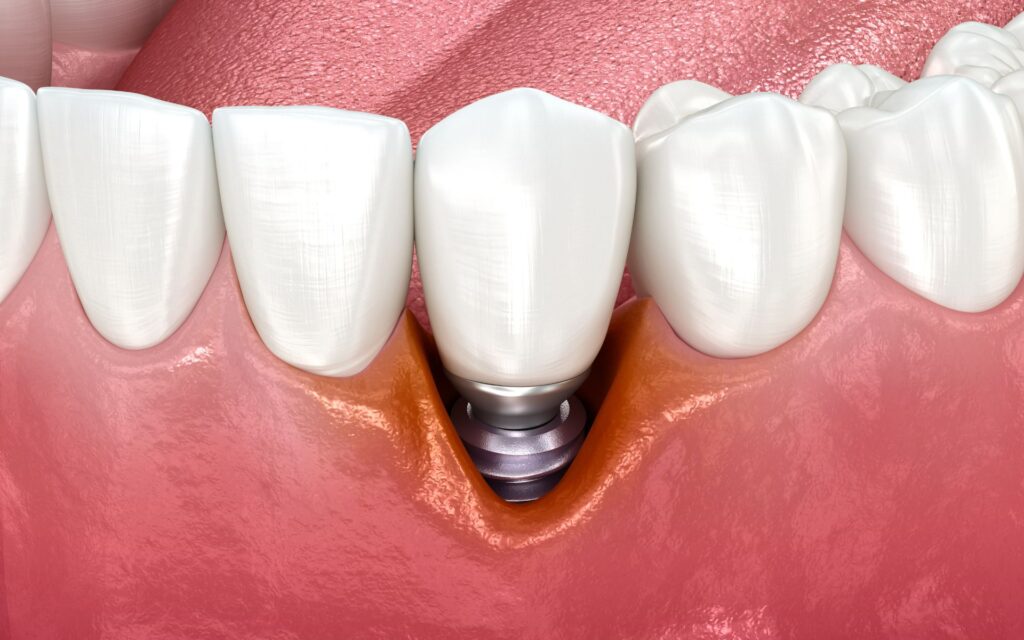 Perimplantitis around a dental implant: Smoking may increase the risk of this complication