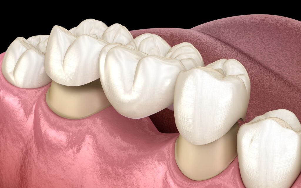 Ponte Dentali Centri Dentali Zanardi