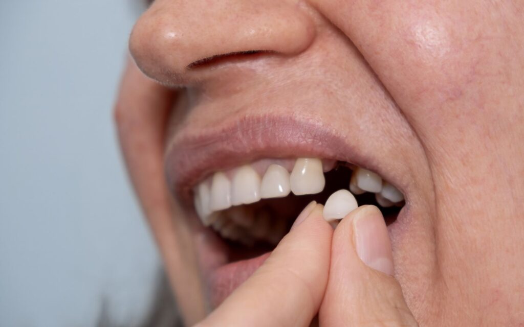 Le cause della perdita di denti: non è solo una questione di età