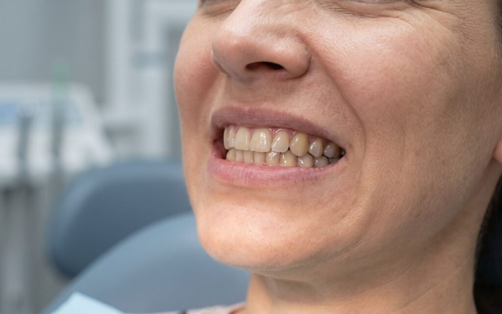 Fumo Igiene e Bruxismo sono solo alcune delle cause della perdita di denti