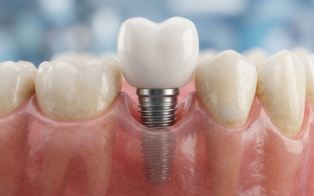 Impianti dentali e overdenture come soluzioni per sostituire i denti che cadono